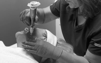 Why Fall Is the Perfect Time for Microneedling